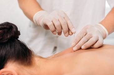 Acupuncture Acupuncture